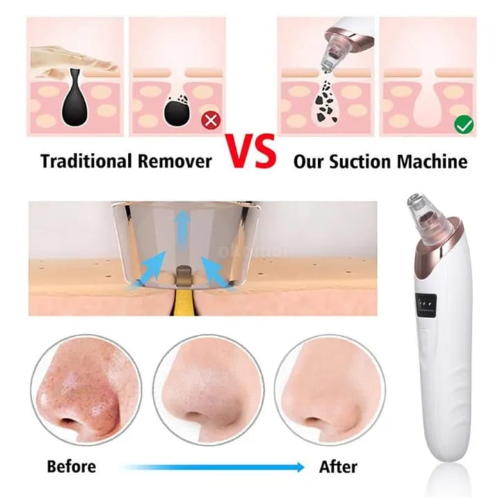Electric Face Vacuum Blackhead Remover – Deep Pore Cleaner for Nose & Face | Portable Skincare Tool
